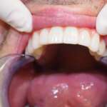 Dental Implant tooth Restoration